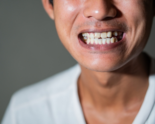 At-Home Care Guide Before You Arrive for Emergency Dentist