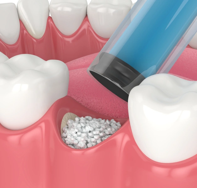 bone grafting in erdenheim