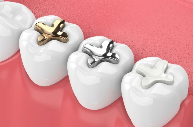 composite fillings in erdenheim