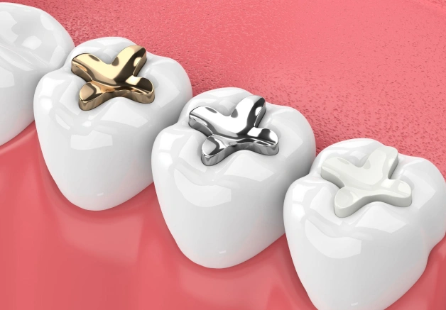 Composite fillings in Erdenheim