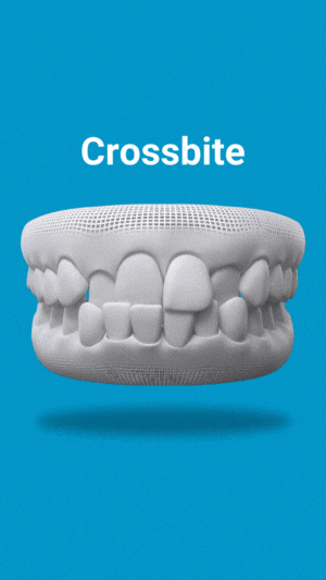 crossbite