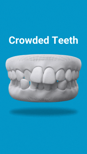 crowded teeth