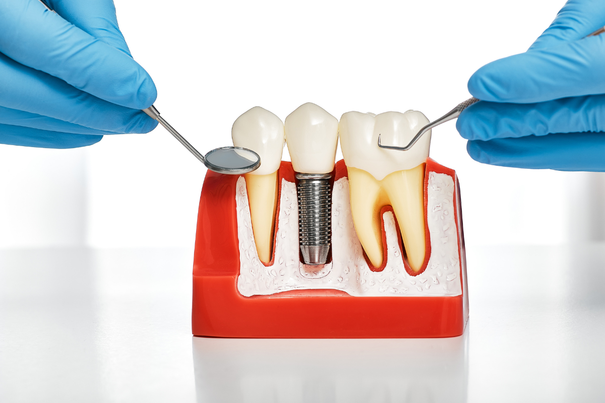 Dental Implants for Seniors