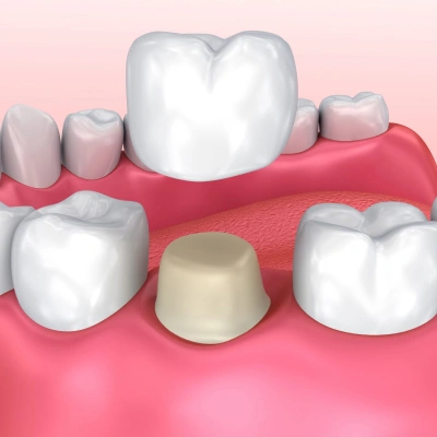 dental replacement crown in erdenheim