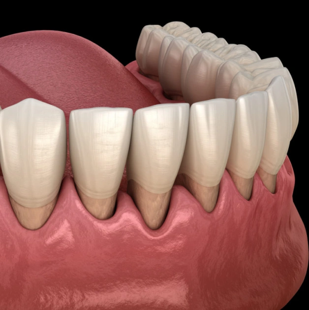 gum grafting in erdenheim