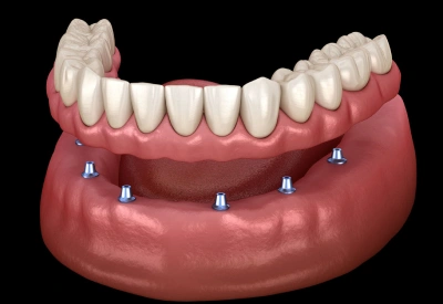 implant supported dentures