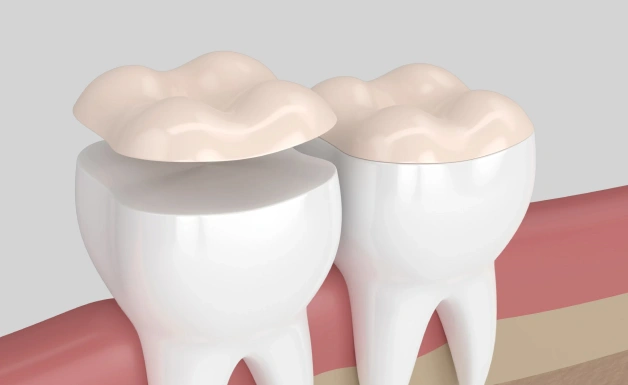 inlays and onlays in erdenheim