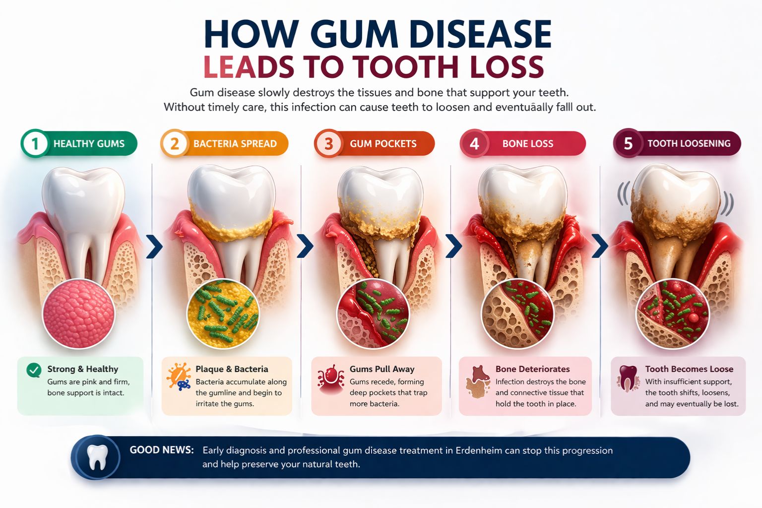 gum disease leads to tooth loss